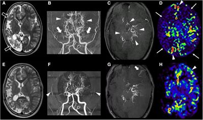 Case report: Revascularization failure in NF1-related moyamoya syndrome after selumetinib: A possible pathophysiological correlation?